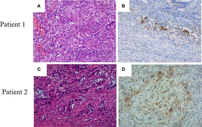 Clinical and genetic characteristics in pancreatic cancer from Chinese patients revealed by whole exome sequencing